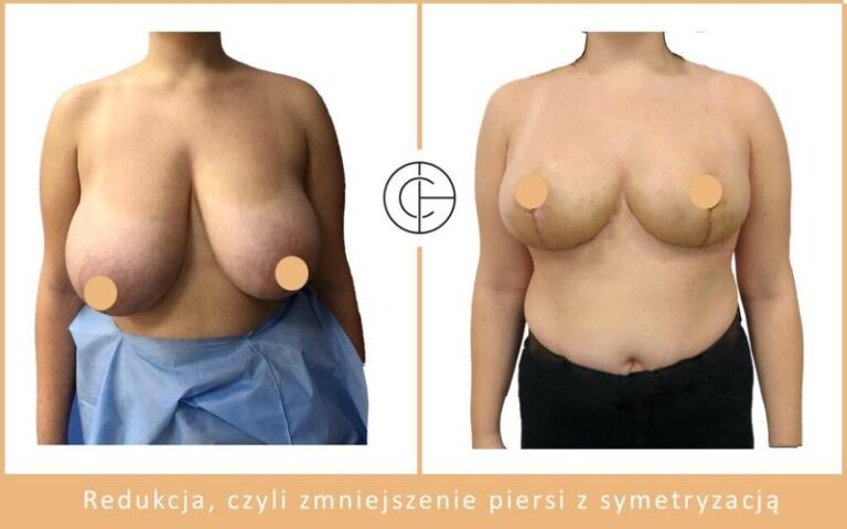 Skuteczne metody na zmniejszenie rozmiaru biustu – co warto wiedzieć?