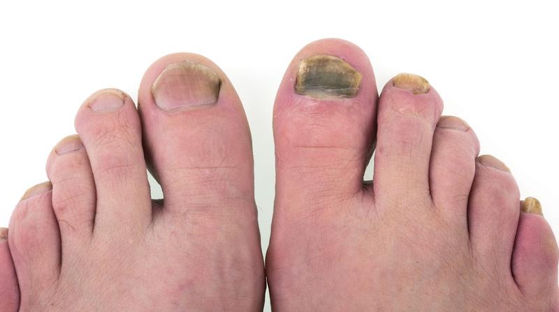 Leczenie grzybicy paznokci