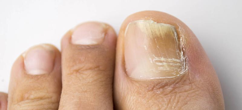 Przyczyny i objawy grzybicy