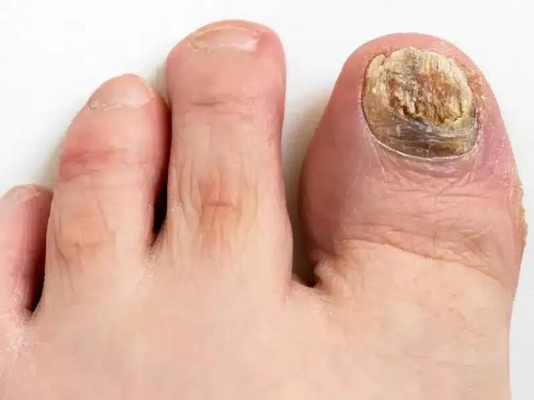 Czy żółte paznokcie to objaw grzybicy? Sprawdź, co powinieneś wiedzieć!
