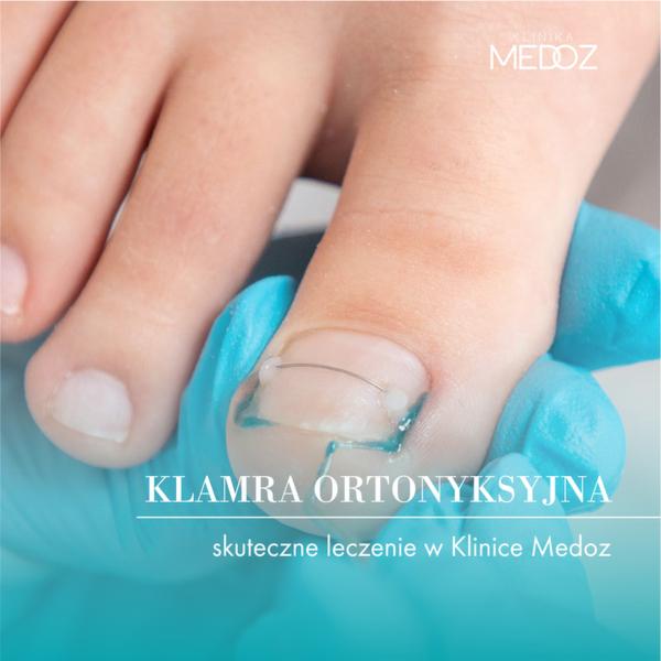 Ból przy klamrze