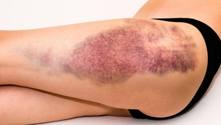 Jak długo potrwa, zanim siniak pod paznokciem zejdzie?